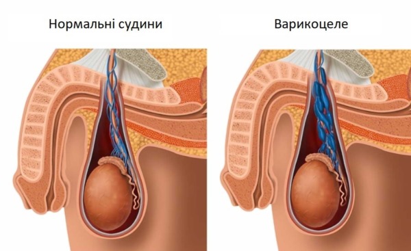Варикоцеле – захворювання статевої системи у чоловіків
