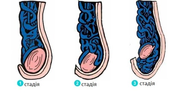 Варикоцеле – захворювання статевої системи у чоловіків